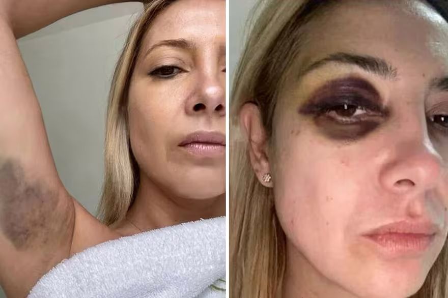 Brutales imágenes de Fabiola Yáñez con moretones en brazos y el rostro